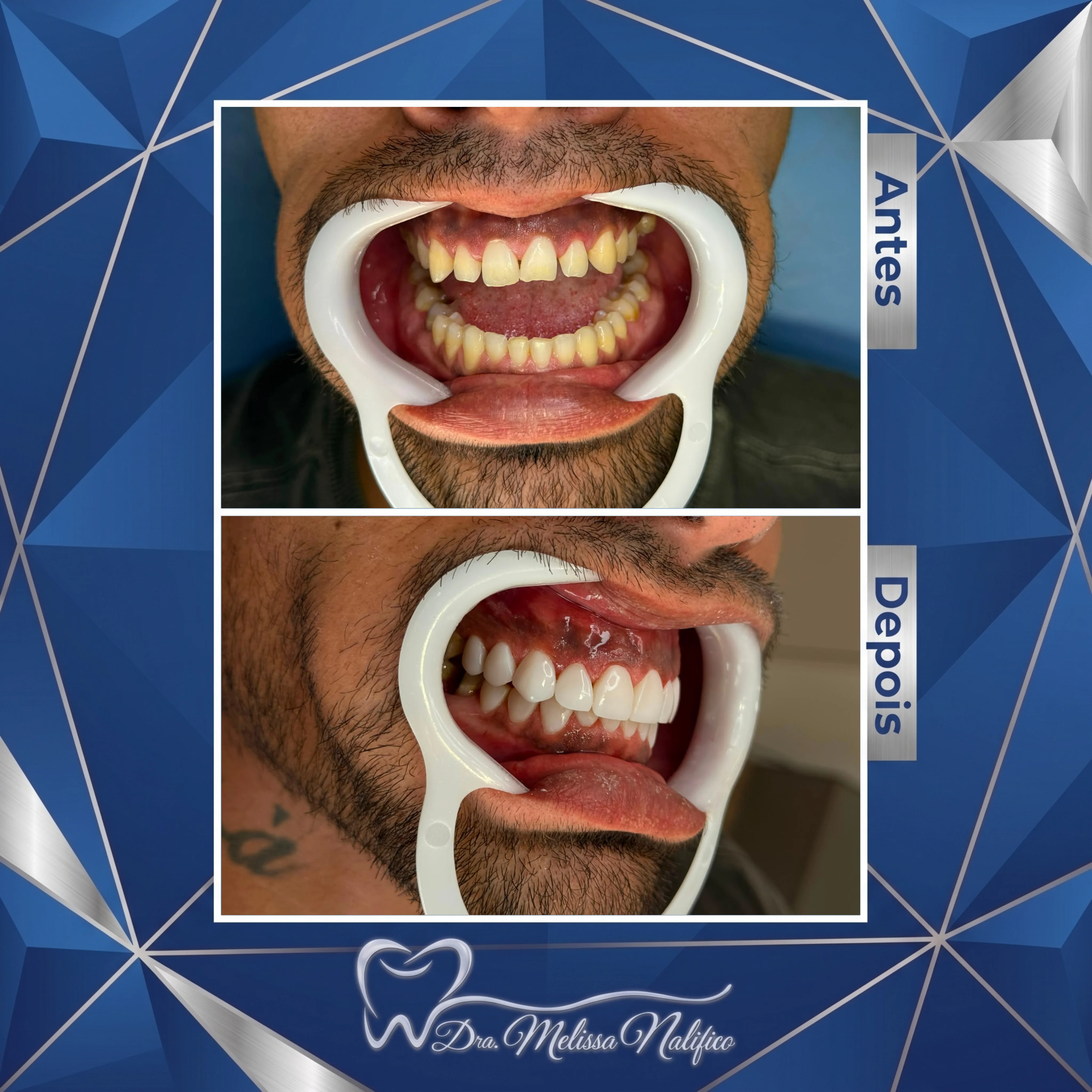 Antes e Depois Paciente 2